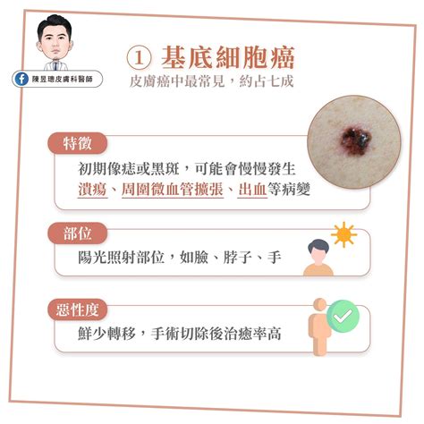 身上痣|皮膚長痣、長斑是皮膚癌前兆？皮膚癌初期4大症狀快。